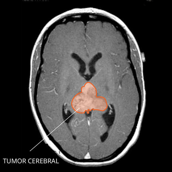 Imagen por resonancia magnética (IRM) del tumor teratoide rabdoide atípico en el cerebro.
