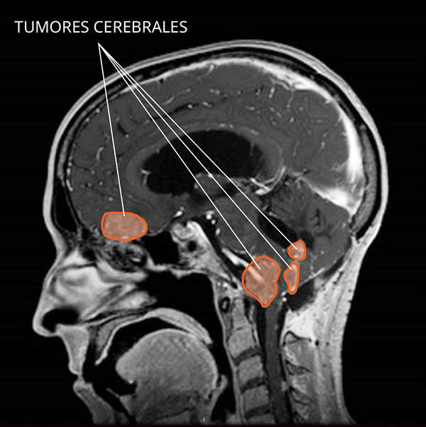 Imagen por resonancia magnética (IRM) de los tumores de plexo coroideo en el cerebro.