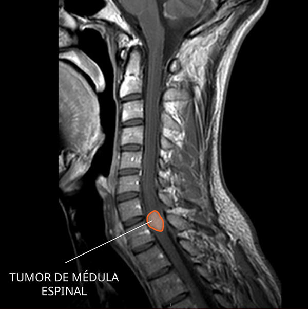 Imagen por resonancia magnética (IRM) de un ependimoma en la médula espinal.