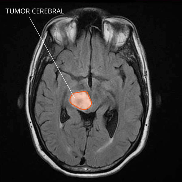 Imagen por resonancia magnética (IRM) de un glioma difuso de línea media en el cerebro.