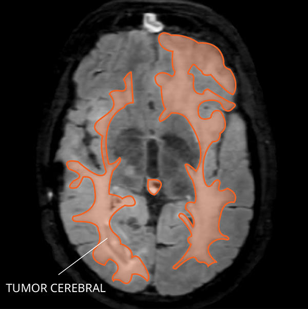 Imagen por resonancia magnética (IRM) de gliomatosis cerebral en el cerebro.