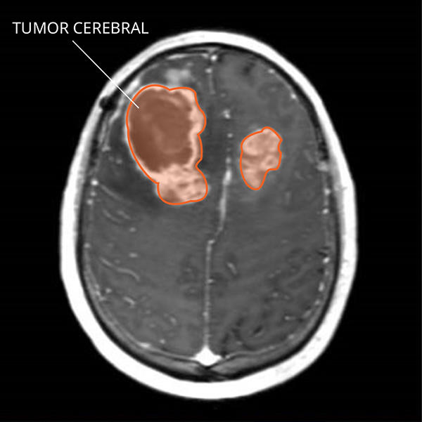  Imagen por resonancia magnética (IRM) de tumores de gliosarcoma en el cerebro.