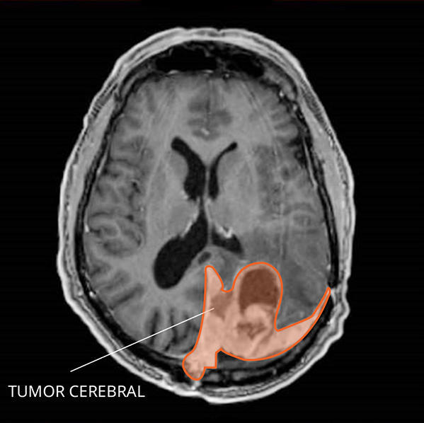 Imagen por resonancia magnética (IRM) de un meningioma en el cerebro.