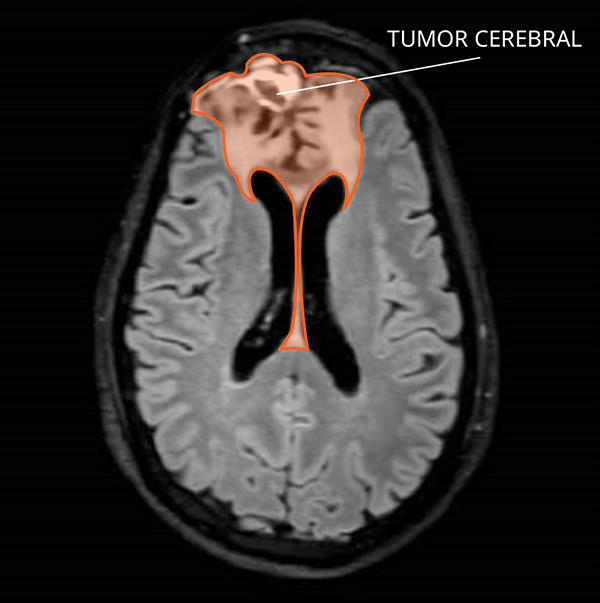 Imagen por resonancia magnética (IRM) de un oligodendroglioma en el cerebro.
