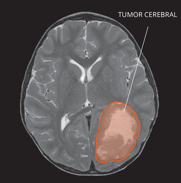 Imagen por resonancia magnética (IRM) de un tumor neuroectodérmico primitivo (TNEP) en el cerebro.