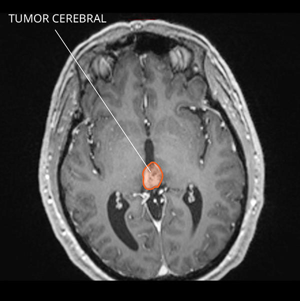 Imagen por resonancia magnética (IRM) de un tumor de la región pineal en el cerebro.