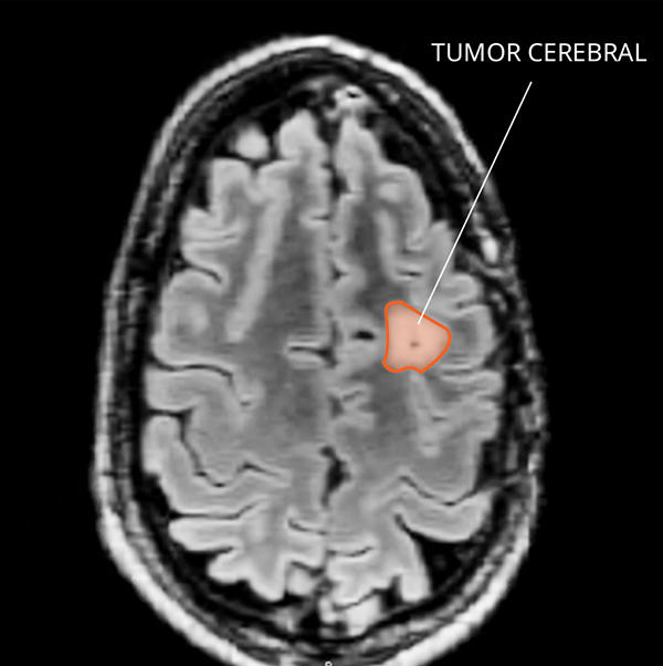 Imagen por resonancia magnética (IRM) de un xantoastrocitoma en el cerebro.