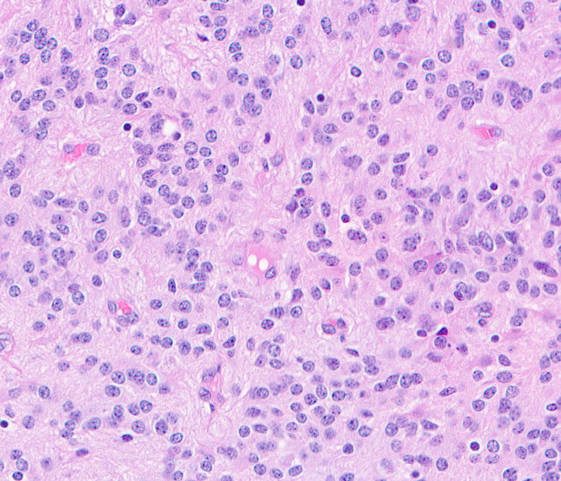 Microscopy image of tumor tissue