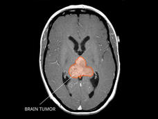 MRI scan showing an AT/RT tumor