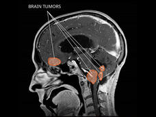 MRI of choroid plexus tumors in the brain.