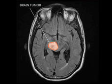 MRI of a diffuse midline glioma in the brain.
