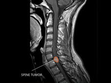 MRI of an ependymoma in the spine.