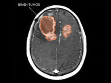 MRI of gliosarcoma tumors in the brain.