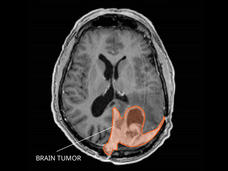 MRI of a meningioma in the brain.