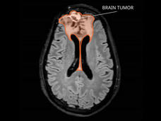 MRI of an oligodendroglioma in the brain.