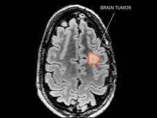 MRI of a pleomorphic xanthoastrocytoma (PXA) tumor in the brain.