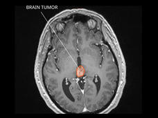 Pineal-region-tumor-Thumbnail