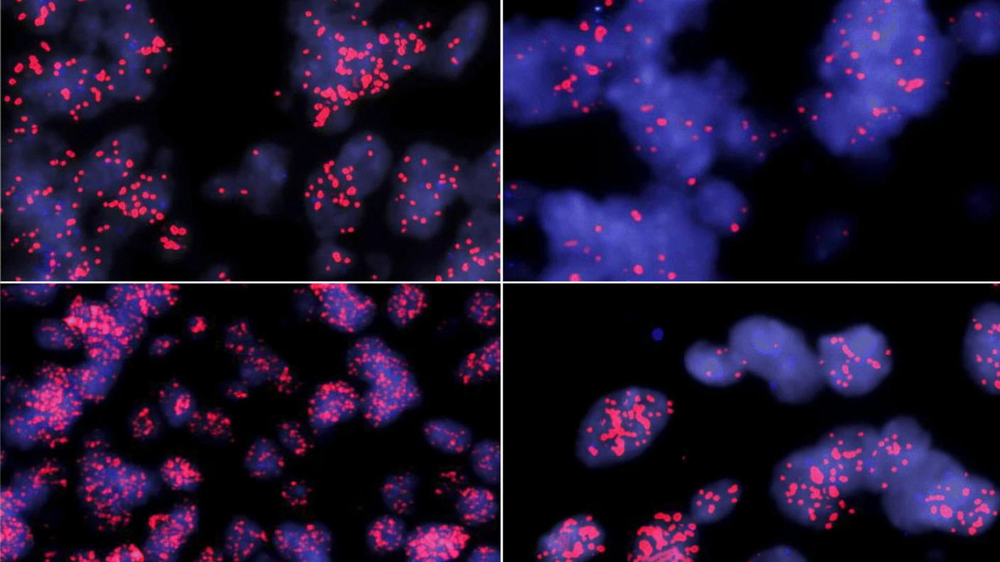 Microscopy images of four different MYCN amplified ependymomas