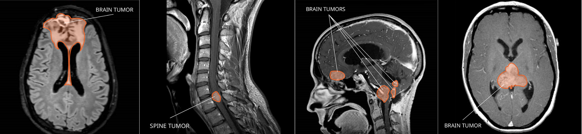 MRI images of brain and spine tumors. 