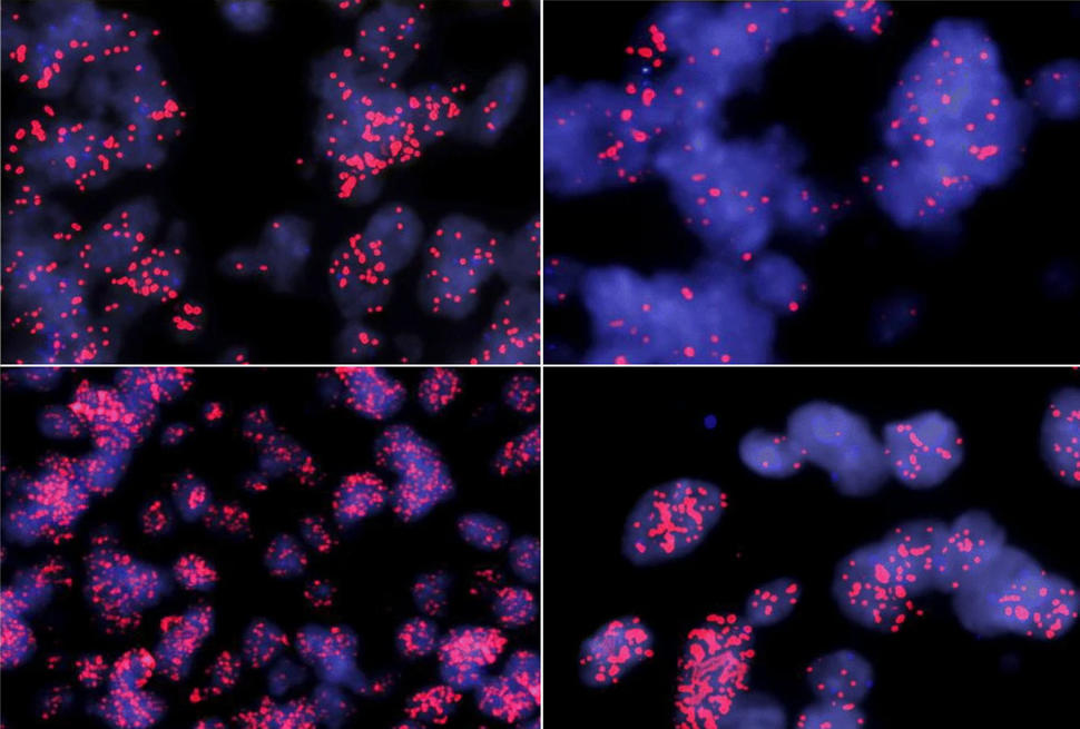 Microscopy images of four different MYCN amplified ependymomas