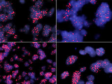 Microscopy images of four different MYCN amplified ependymomas