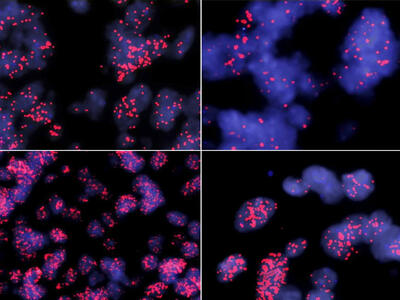 Microscopy images of four different MYCN amplified ependymomas