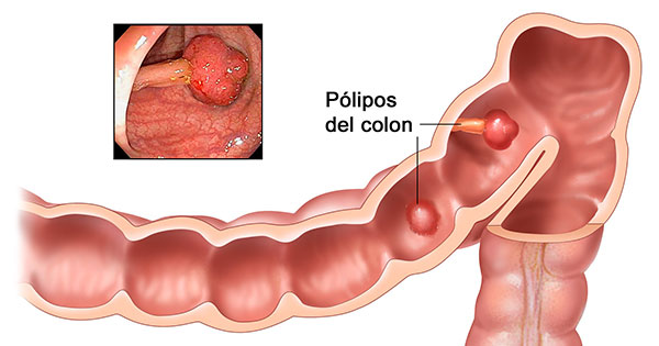 próstata con bulto adenomatoso próstata con bulto adenomatoso