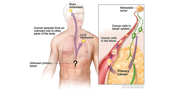 Metastatic cancer can be cured, Lung Cancer or Metastasis to Lung? pancreatic cancer familial
