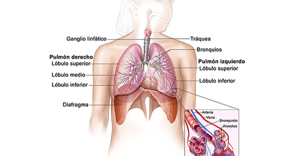 que es cancer al pulmon