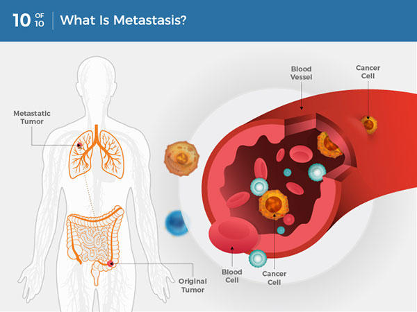 Metastatic cancer define