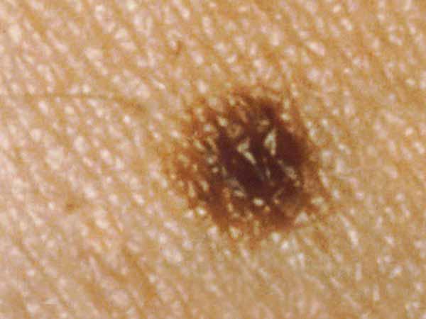 This common mole is 2 millimeters in diameter.