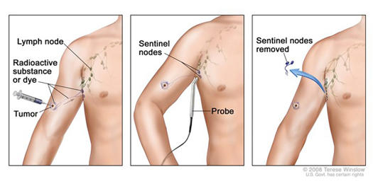 Sentinel lymph node biopsy in a patient with melanoma