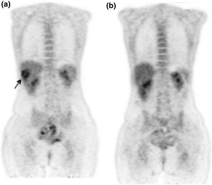 Proyecciones frontales de una tomografía por emisión de positrones con F‐FDG del abdomen (a) antes del tratamiento con radioterapia corporal estereotáctica ablativa y (b) tres meses después.