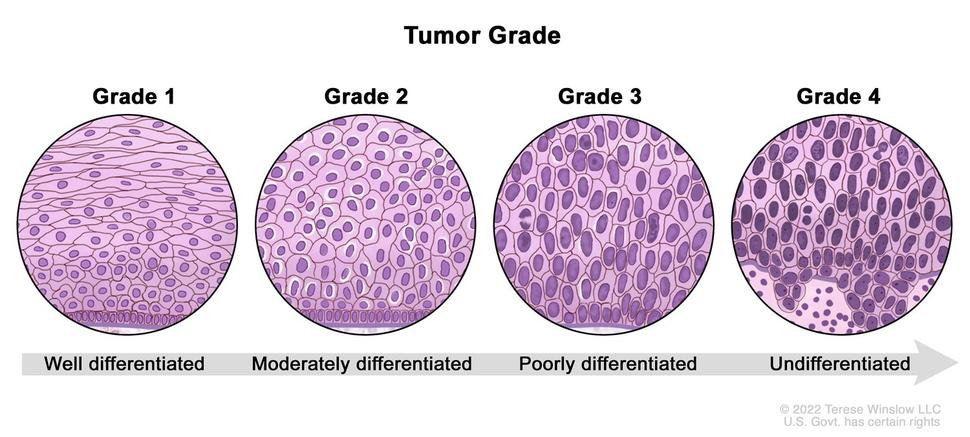 Illustration of 4 sets of microscopic view of cells. The first is Grade 1 and shows well differentiated cells that look almost normal. Next is Grade 2 that is moderately differentiated and looks a little less normal. Grade 3 is next and shows poorly differentiated cells that have lost their structure. Last is Grade 4 which shows undifferentiated cells that look the most abnormal. 