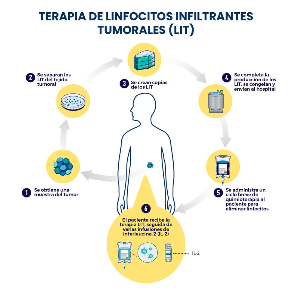 Infografía que describe la terapia de linfocitos infiltrantes tumorales (LIT) desde que se obtiene la muestra del tumor hasta que el paciente recibe la terapia, seguida de las infusiones de interleucina-2.