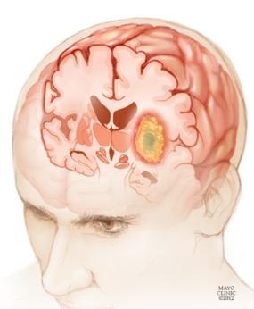 squamous cell carcinoma skin treatment