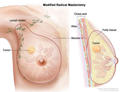 A drawing shows where a modified radical mastectomy removes tissue, including the entire breast and lymph nodes under the arm.
