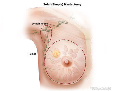 A drawing shows where a total, or simple, mastectomy might remove tissue, such as the entire breast or lymph nodes under the arm.