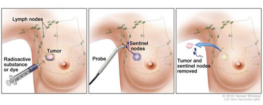 Active surveillance of patients who have sentinel node positive