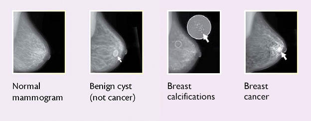 Breast Changes and Conditions - National Cancer Institute