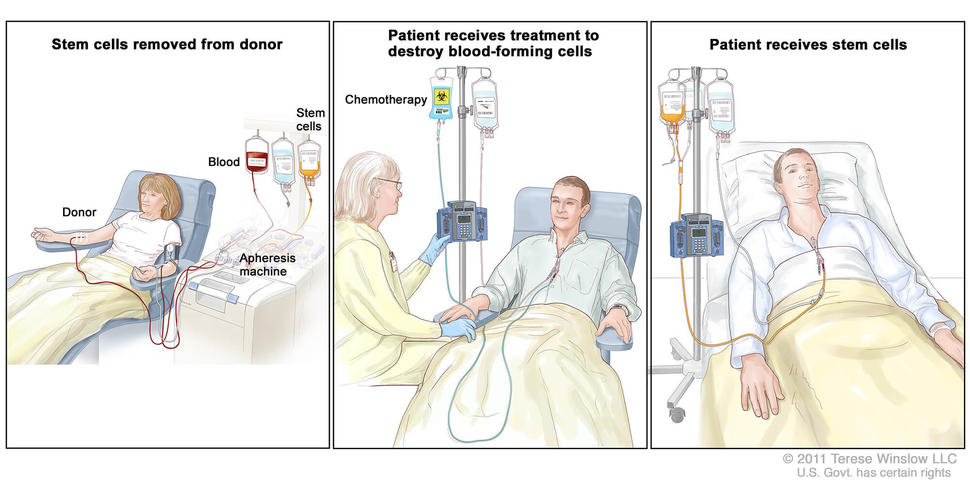 no treatment for mesothelioma