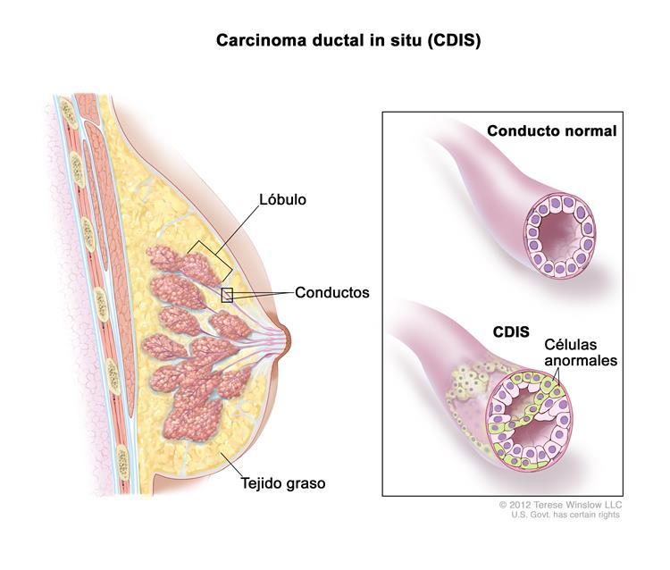 que es cancer in situ