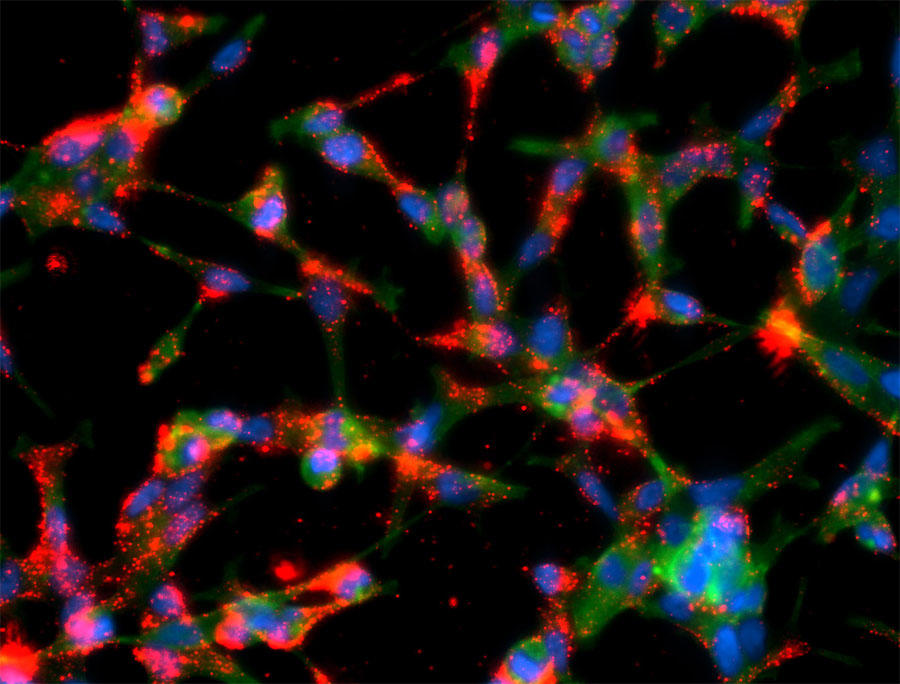 Prostate cancer cells interacting with polymeric nanoparticles coated with targeting molecules.