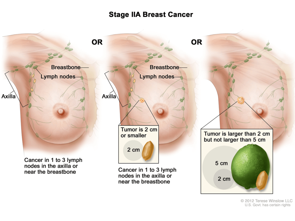 FDA for HER2-Positive Breast Cancer 
