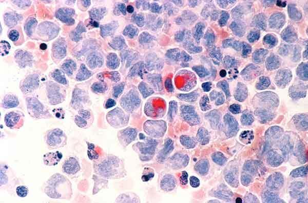 Human cells with acute myelocytic leukemia as seen through a microscope