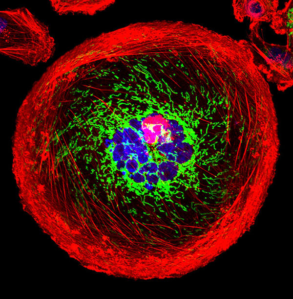 A polyploid giant cancer cell from triple-negative breast cancer in which actin is red, mitochondria are green, and nuclear DNA is blue.