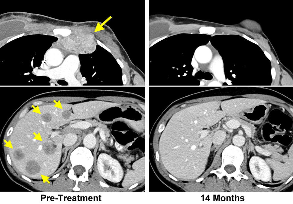 CT images show tumors in the chest wall and liver of a breast cancer patient. Images after immunotherapy treatment show the tumors are gone. 