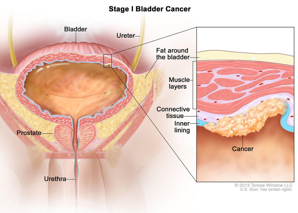 Prostate and bladder cancer survival rate