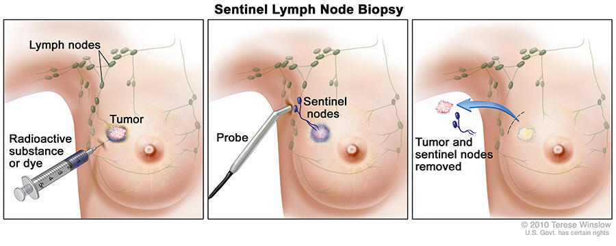 Lymph Node Removal in Early-Stage Breast Cancer - National ... lymph node locations diagram 