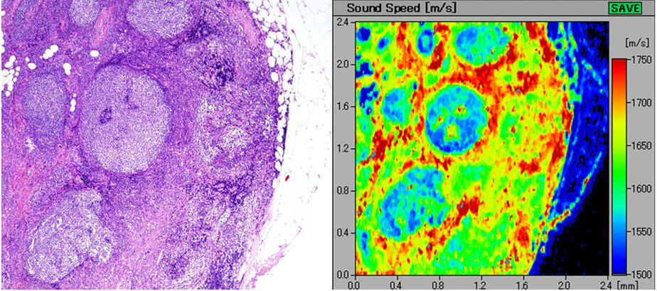 Follicular lymphoma cells stained purple (left) and a scanning acoustic microscopy image of follicular lymphoma cells in neon green, red, and blue (right)